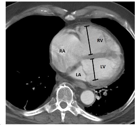 rv lv ratio on ct